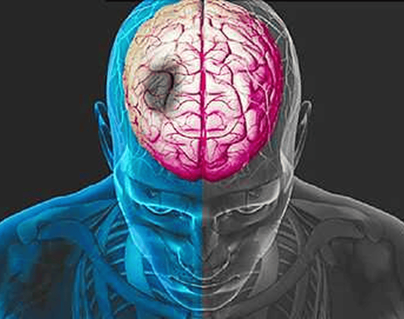 Brain illustration with highlighted damage