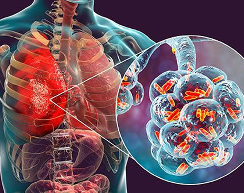 Respiratory infection concept with bacterial close-up